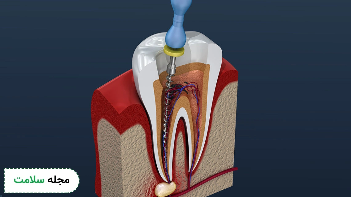 root canal treatment