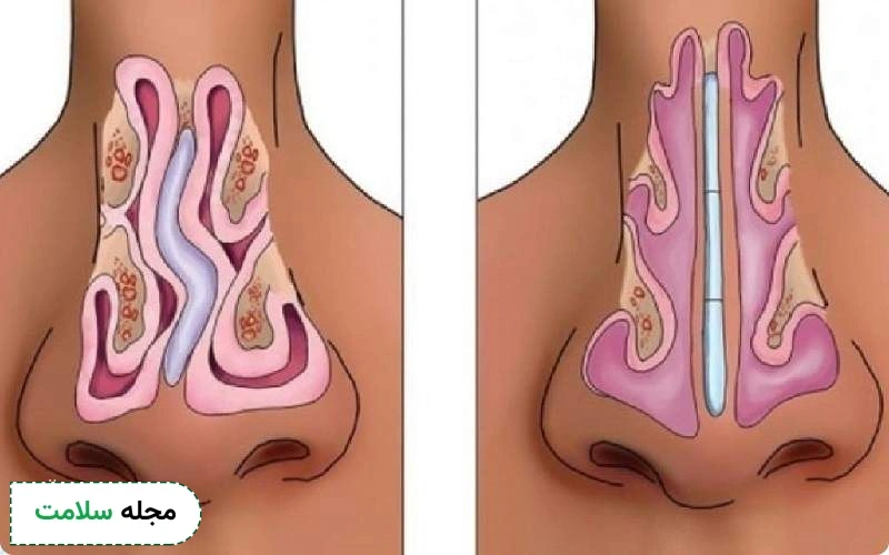 انحراف بینی باعث تنگی نفس میشه؟
