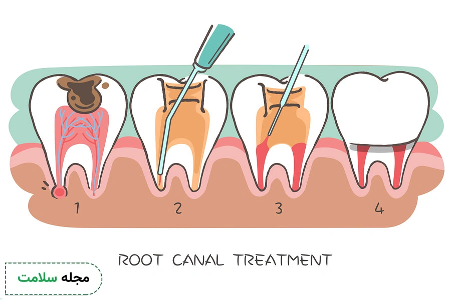 root canal treatment