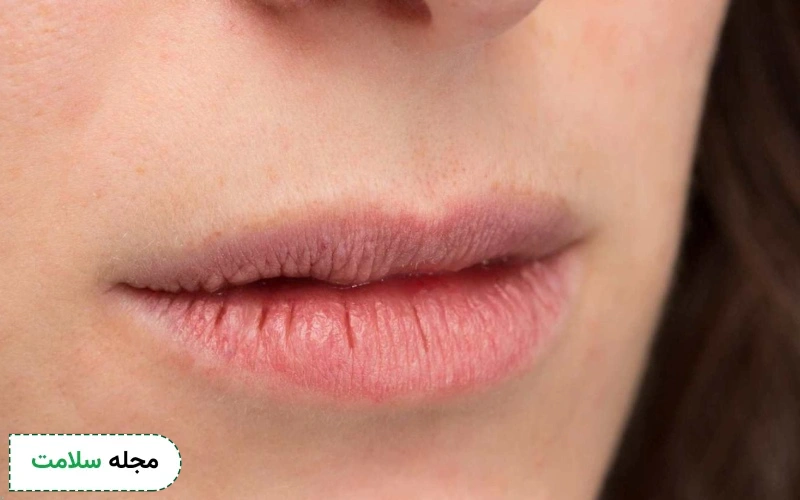 خشکی لب و دهان برای چیست؟