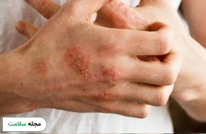 Blisters-of-impetigo-on-the-hand
