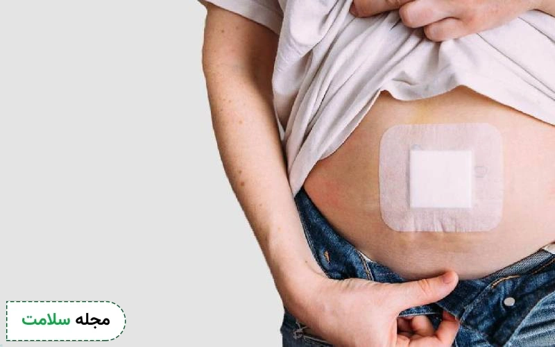 بعد از عمل فتق چند روز باید استراحت کرد؟
