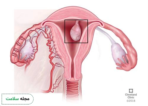 uterine polyp