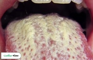 Thrush in the mouth