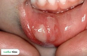 canker sore
