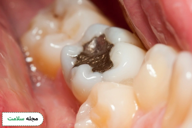 dental filling