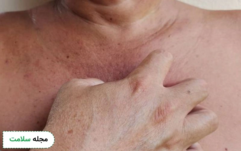 بیماری نیمن پیک؛ راهنمای کامل برای زندگی با سندرم Niemann-Pick