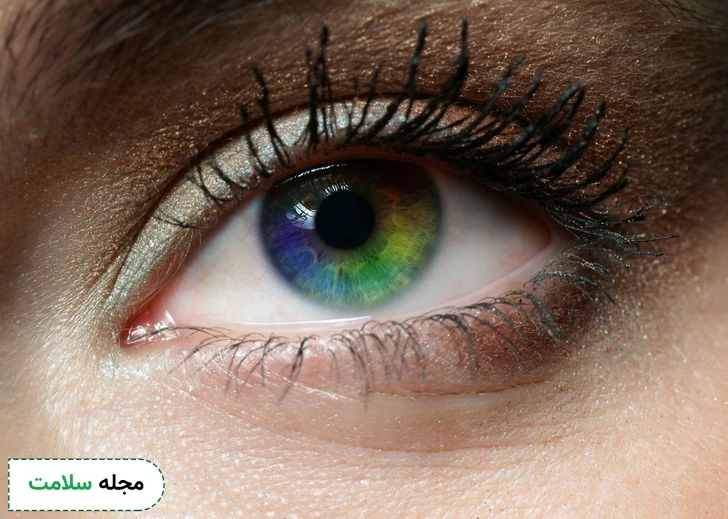 eye color change with iol
