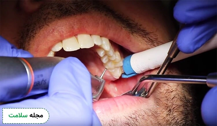 dentist filling cavitiy