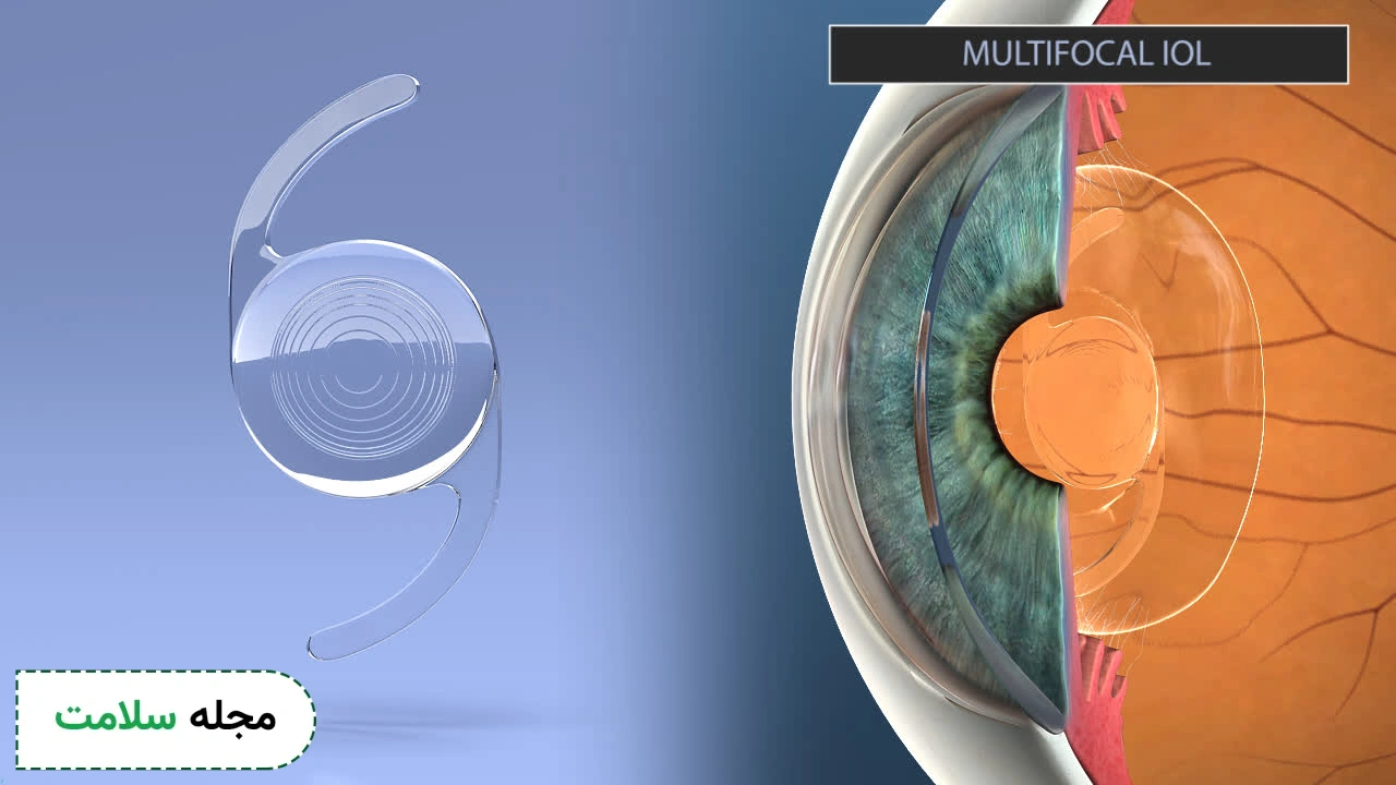 Intraocular Lens Implants