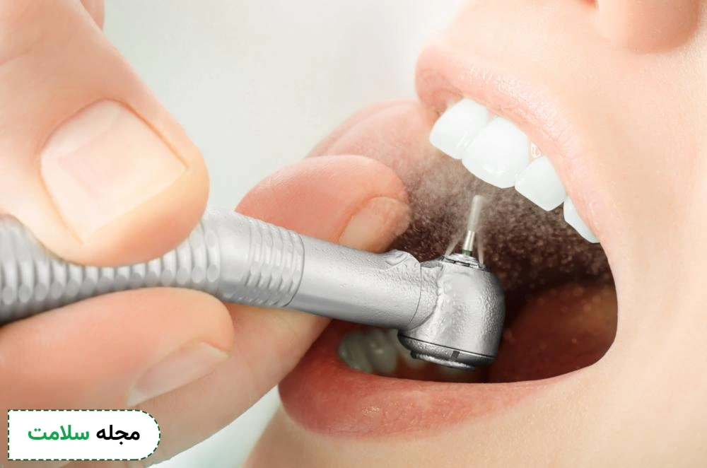 dental filling