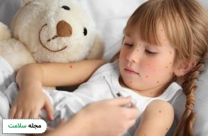Chickenpox