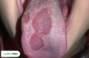 geographic tongue