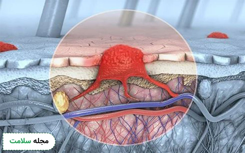 تومور کارسینوما چیست؟ این سرطان چه علائمی دارد و چگونه به وجود می آید؟
