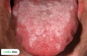 But oral plan