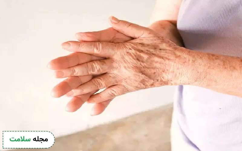 علت کک و مک روی دست چیست؟