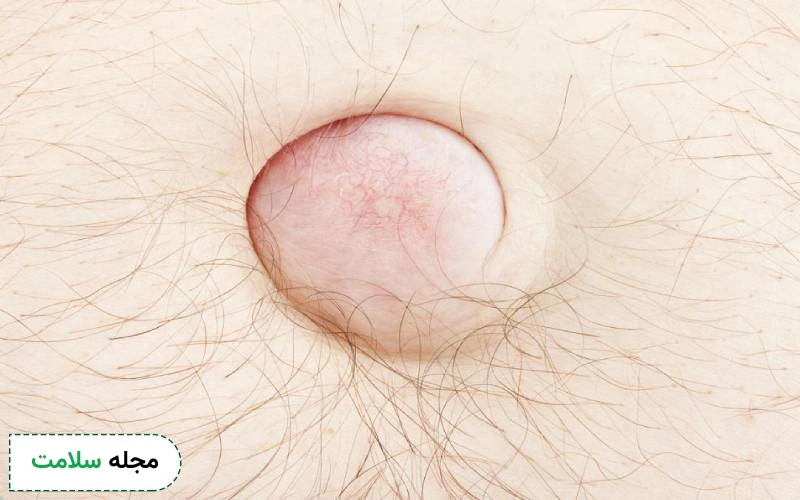 بیماری فتق ناف چیست؟