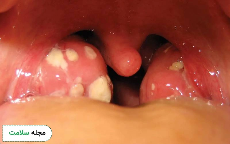 عکس لوزه گلو با دانههای سفید