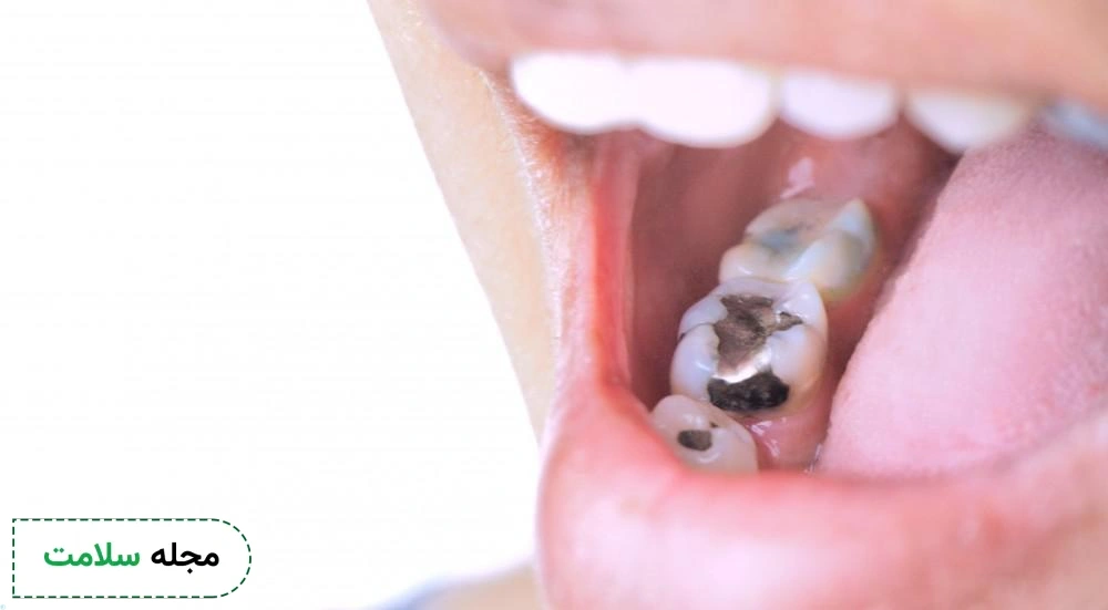 dental filling with amalgam