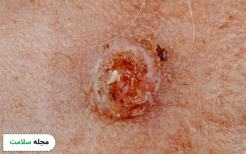 عکس سرطان سلول سنگفرشی