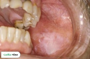 Leukoplakia