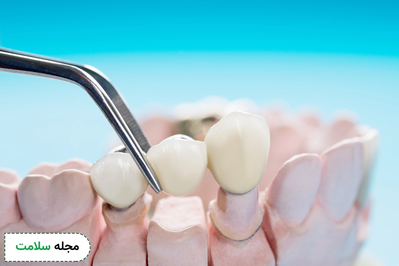 dental prostheses