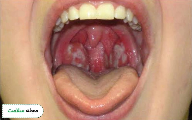 فارنژیت یا التهاب گلو چگونه تشخیص داده می شود؟