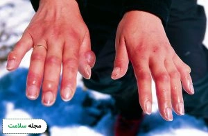 Cold-blisters