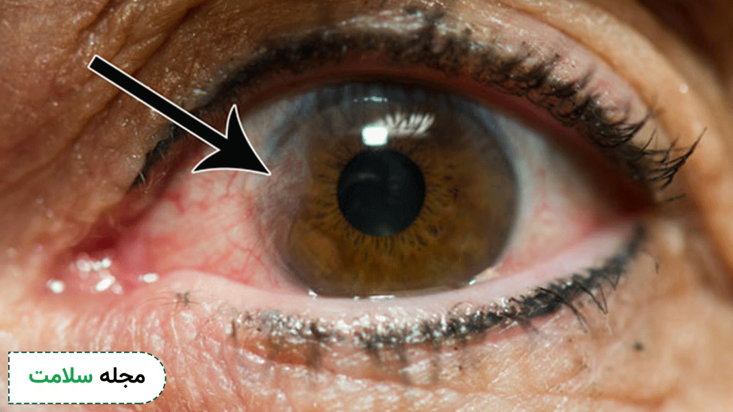 Pterygium-symptoms