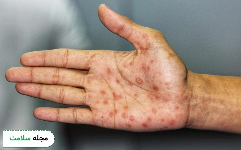 سیفلیس چیست و روش درمان آن چگونه است؟