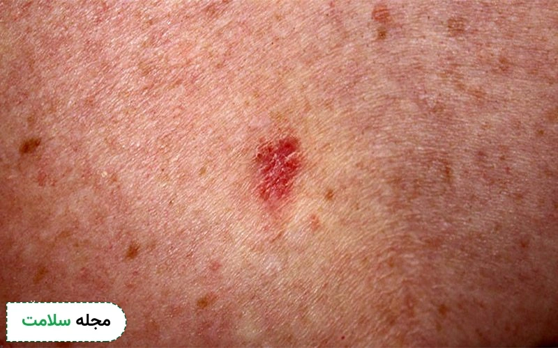 علت ایجاد کارسینوم سلول بازال چیست؟