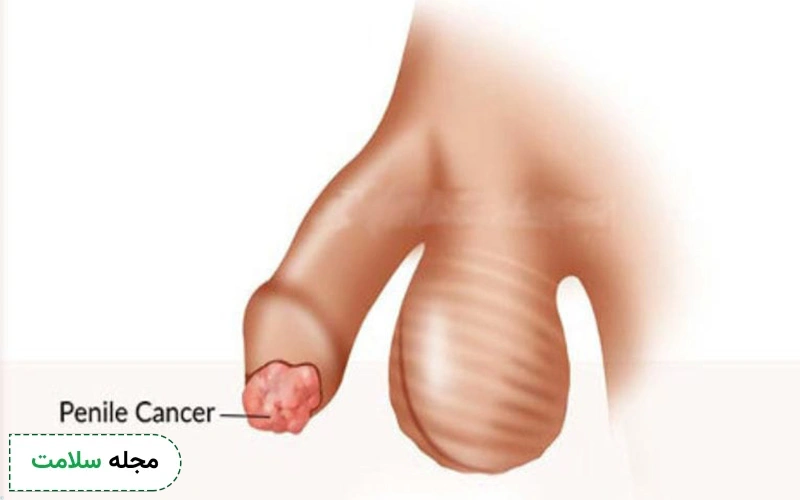 یکی از علائم اصلی تومور آلت تناسلی ایجاد زخم یا توده روی آلت تناسلی است.