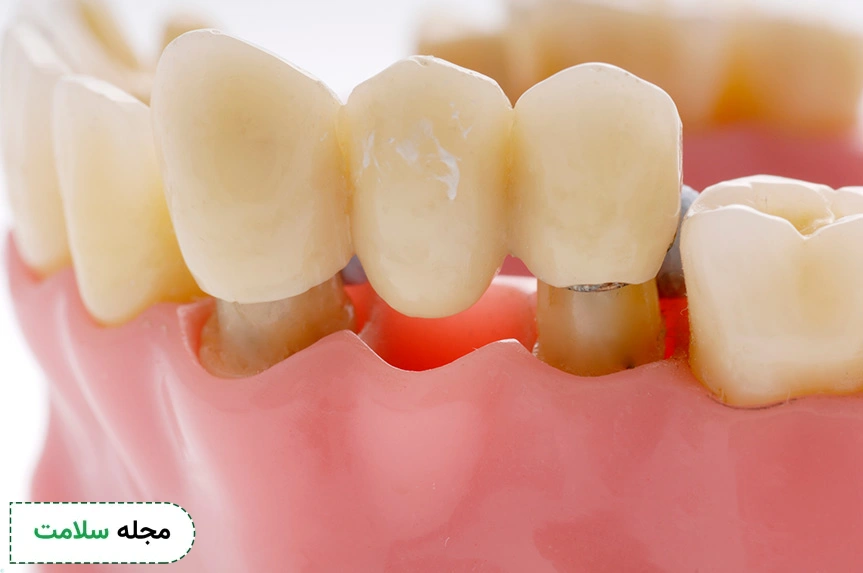 bridge restoration dental