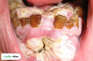 Oral-cancer