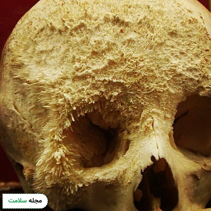 سرطان استخوان چیست؟ علائم، راه‌های تشخیص و روش‌های درمان