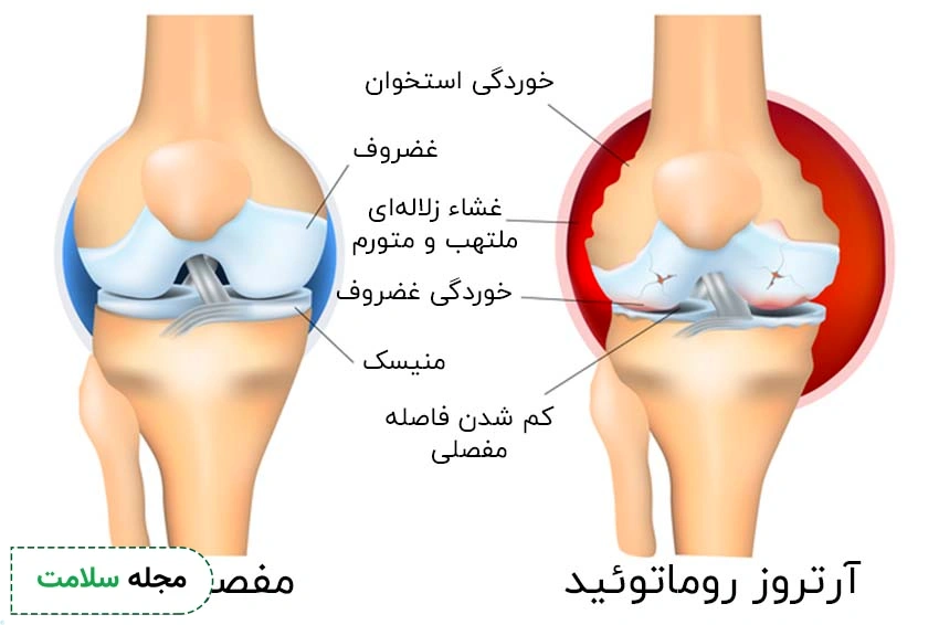 مقایسه زانوی درگیر شده با آرتروز روماتوئید با زانوی سالم
