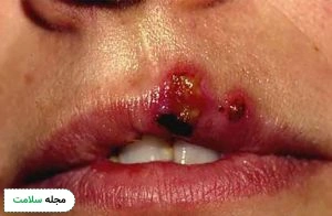 herpes-simplex