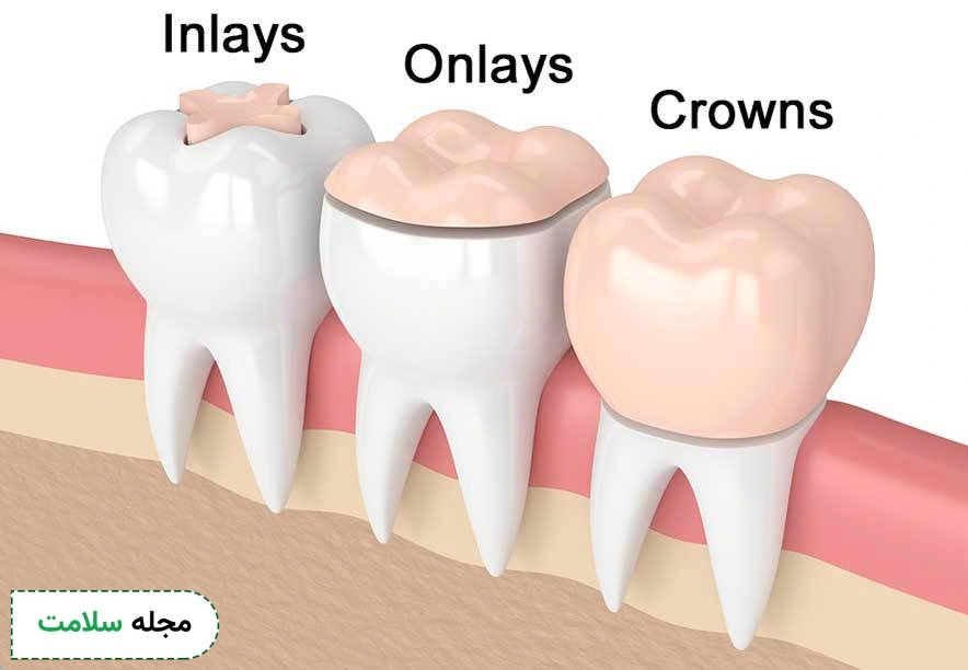 indirect dental filling