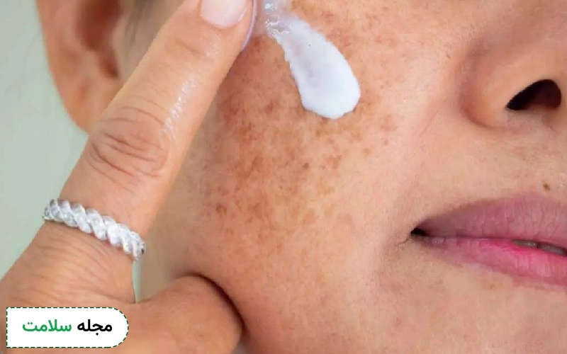 آیا خمیردندان برای کک و مک مناسب است؟