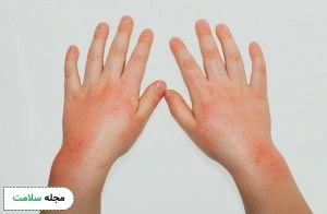 Contact-dermatitis-blisters