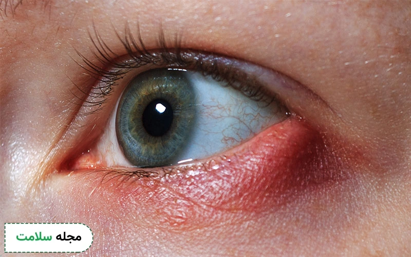 گل مژه چیست و چه علائمی دارد؟