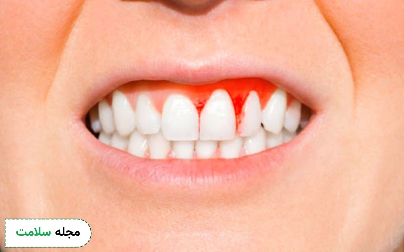 علت عفونت حاد و عفونت مزمن لثه چیست؟