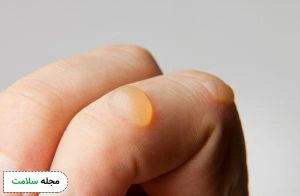 Blisters-caused-by-chemicals