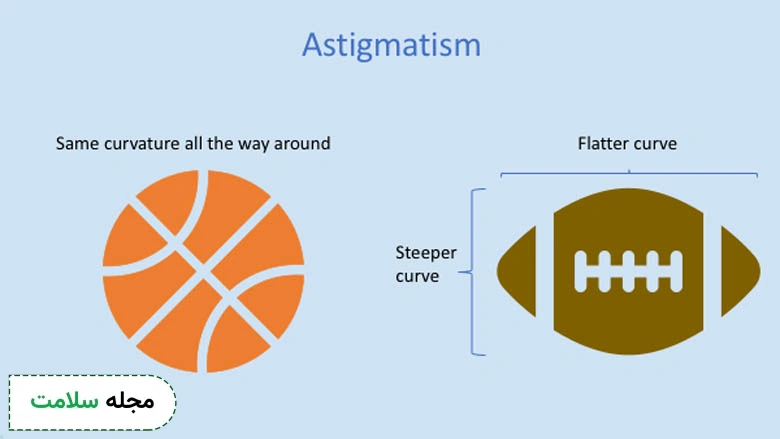 astigmatism