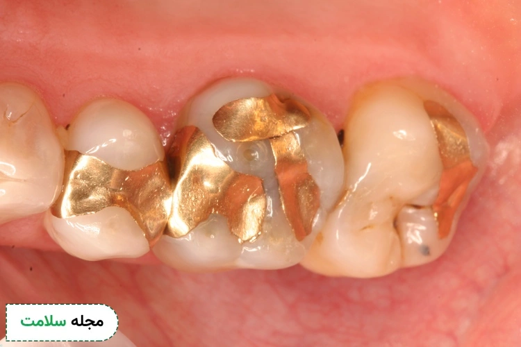 gold dental filling