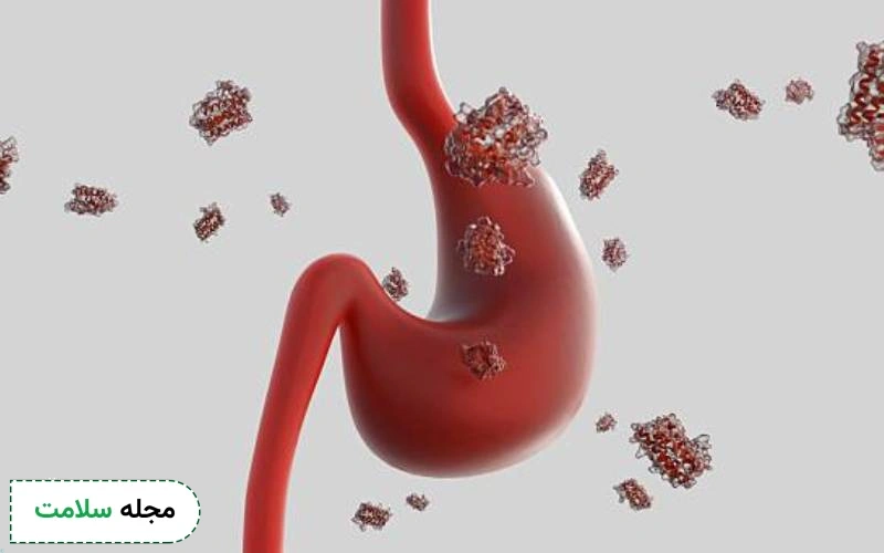 سرطان معده چیست؟ تمام آنچه باید از سرطان معده بدانید