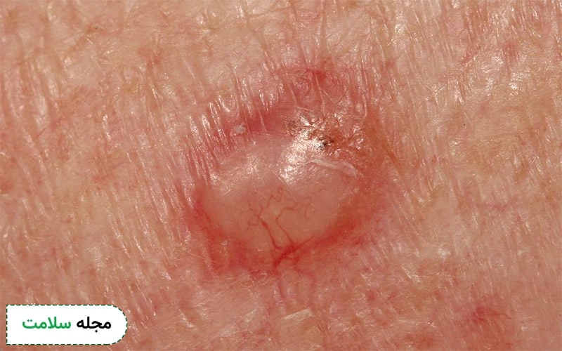 علائم کارسینوم سلول بازال