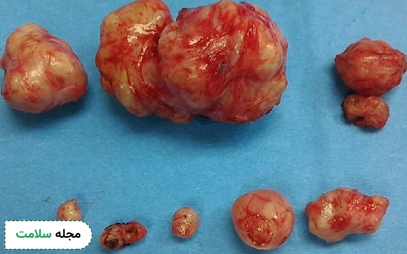 عکس فیبروم رحمی چه شکلی است؟