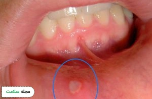 Folate deficiency