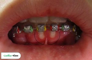 Gingivomatitis